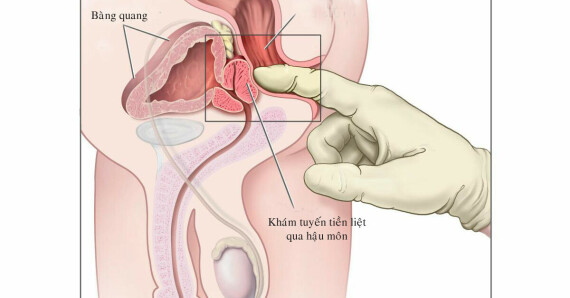 Khám tuyến tiền liệt qua đường trực tràng