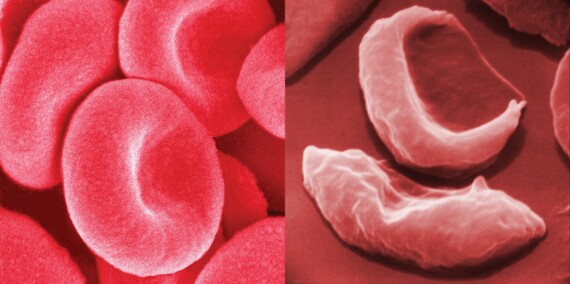Hồng cầu binhg thường (tay trái) và hồng cầu hình liềm (tay phải)(nguồn ảnh: https://www.britannica.com/)