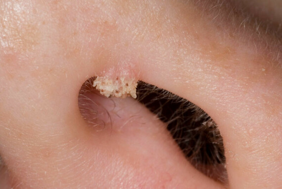 Hạn chế ngoáy mũi và cắn móng tay giúp hạn chế nguy cơ lây nhiễm mụn cóc – Nguồn ảnh: gponline.com