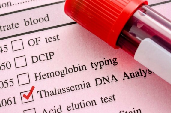 Thalassemia có thể chẩn đoán xác định bằng xét nghiệm máu. Nguồn ảnh: dreamtimes.com