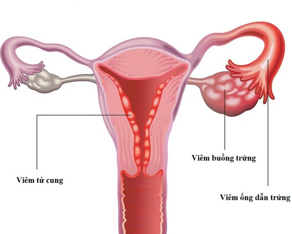 Vi khuẩn xâm nhập qua đường âm đạo gây viêm tử cung, viêm buồng trứng và viêm ống dẫn trứng – Nguồn ảnh: healthdirect.gov.au