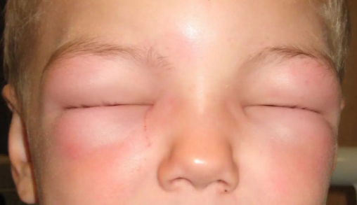 Trẻ bị phù mạch với hai mắt sưng phù.  Nguồn ảnh: Pinterest