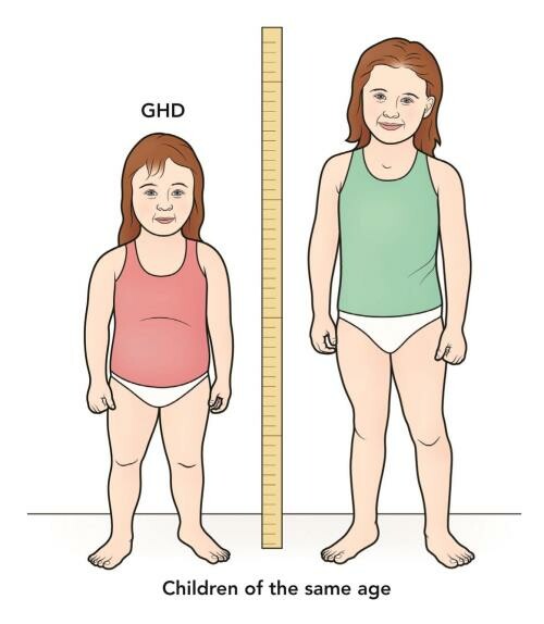 Hình ảnh hai trẻ cùng tuổi thiếu hormon tăng trưởng   và đủ hormon tăng trưởng (nguồn: hormone.org)