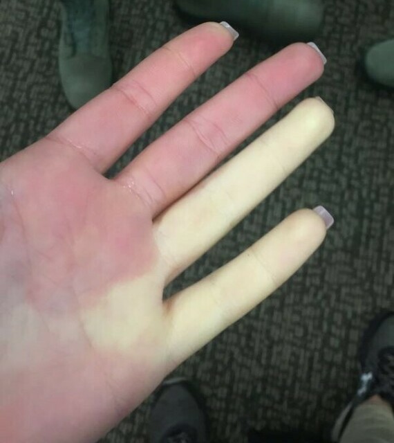 Hiện tượng Raynaud. (Nguồn ảnh: wikipedia)