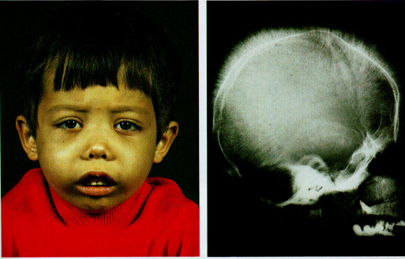 Biến dạng xương vùng mặt là một trong những triệu chứng của bệnh nhân thalassemia. Nguồn ảnh: askhematologist.com