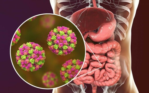 Norovirus là nguyên nhân hàng đầu gây ra bệnh cúm dạ dày ở Hoa Kỳ, chiếm từ 19 triệu đến 21 triệu trường hợp mỗi năm. Nguồn ảnh: Medscape