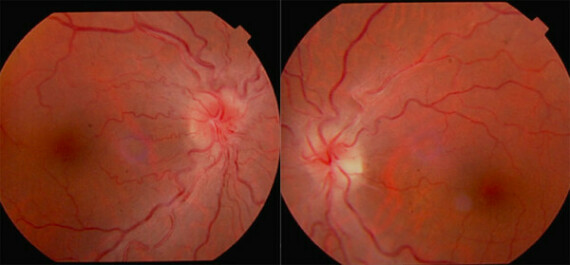Hình ảnh soi đáy mắt ở bệnh nhân bị teo thị giác di truyền của Leber (nguồn ảnh: https://www.entokey.com/) 