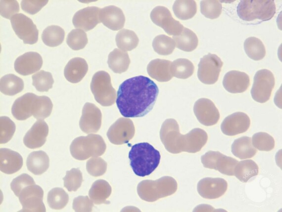  Tế bào lympho T trưởng thành. Nguồn ảnh: americansocietyofhematology.com