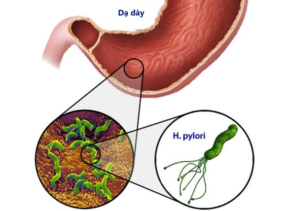 Theo thống kê tại Úc, cứ ba người trên 40 tuổi thì có một người bị nhiễm H. pylori. Nguồn ảnh: iranstar.com