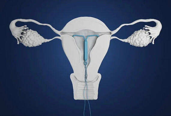Vòng tránh thai nội tiết tố được đặt trong buồng tử cung, có tác dụng giải phóng progestin. (nguồn: medicinenet.com)