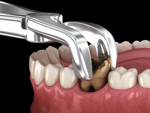 Sau nhổ răng có thể bị đau nhức ở vùng mặt tương ứng với răng được nhổ.(nguồn: impressionsdental.com)