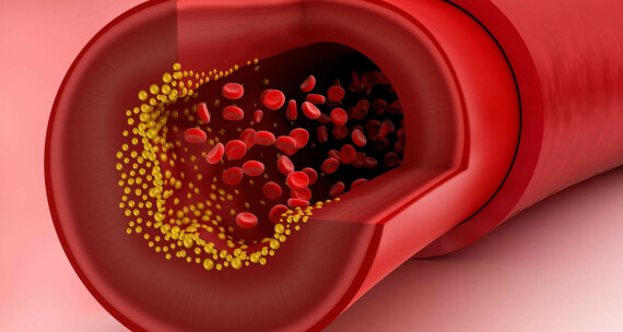 Tăng nguy cơ hình thành các mảng xơ vữa động mạch ở những người có lượng cholesterol cao. Nguồn ảnh: Bulletproof
