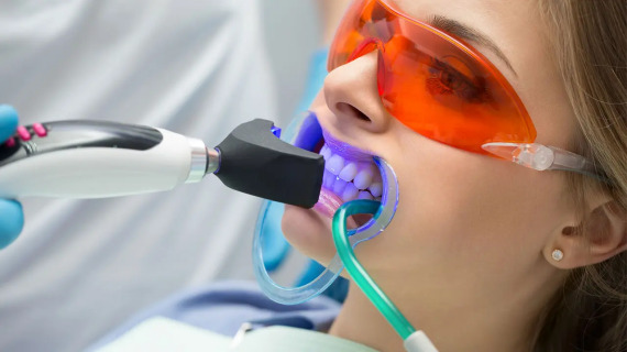 Các sản phẩm tẩy trắng tại phòng khám được bôi trực tiếp lên răng và có thể được sử dụng kết hợp với nhiệt, ánh sáng đặc biệt hoặc tia laser. (nguồn: stegersmiles.com)