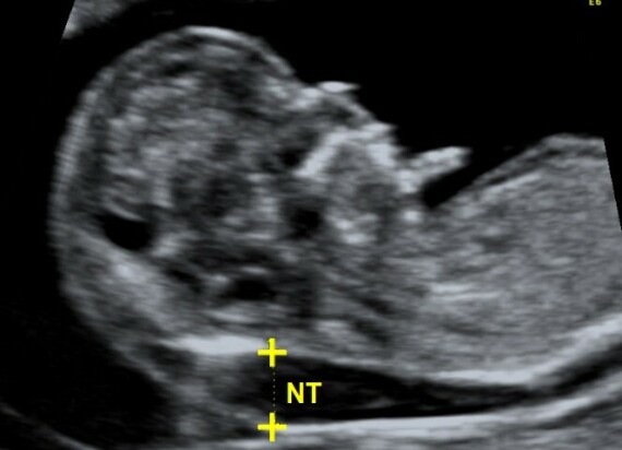 Hình: Siêu âm độ mờ da gáy (NT). Nguồn: The Fetal Medicine Foundation