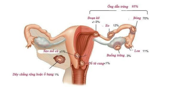 Chửa ngoài tử cung là hiện tượng trứng đã thụ tinh làm tổ ở ống dẫn trứng, sừng tử cung và cổ tử cung – Nguồn ảnh: obgynkey.com
