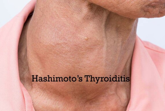 Bướu cổ trong viêm tuyến giáp Hashimoto (nguồn: https://www.askdrshah.com/)