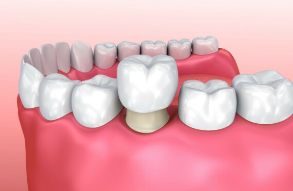 Đối với tình trạng răng bị sâu nhiều hoặc yếu, bạn có thể cần một mão răng - một lớp bọc toàn bộ thân răng cũ thay thế cho thân răng tự nhiên. (nguồn: west85thdental.com)