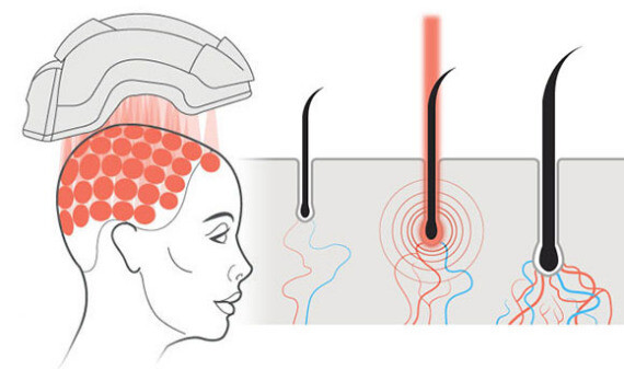 Laser trị liệu cường độ thấp có thể được sử dụng như là một liệu pháp để điều trị chứng rụng tóc. (nguồn: hgspecialist.com)