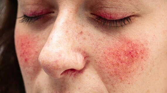 Rosacea gây ảnh hưởng tới thẩm mĩ của người bệnh, do đó có thể gây tác động tiêu cực về tâm lí trong cuộc sống. Nguồn ảnh: MayoClinic