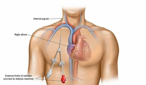 Đặt catheter tĩnh mạch trung tâm. Nguồn: vinmec.com