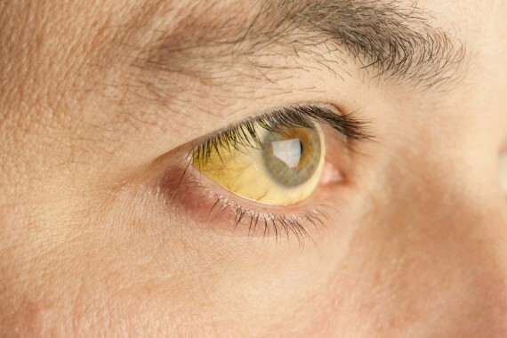 Người bị vàng mắt cần được xét nghiệm bilirubin máu. Nguồn ảnh: Verywellhealth.com