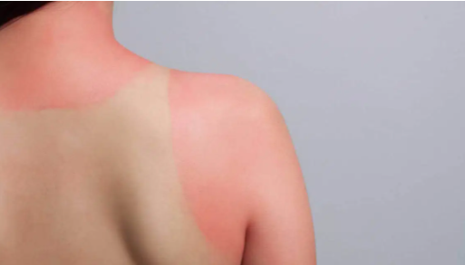 Cháy nắng có thể gây đỏ da và rát. Nguồn ảnh: Pinterest