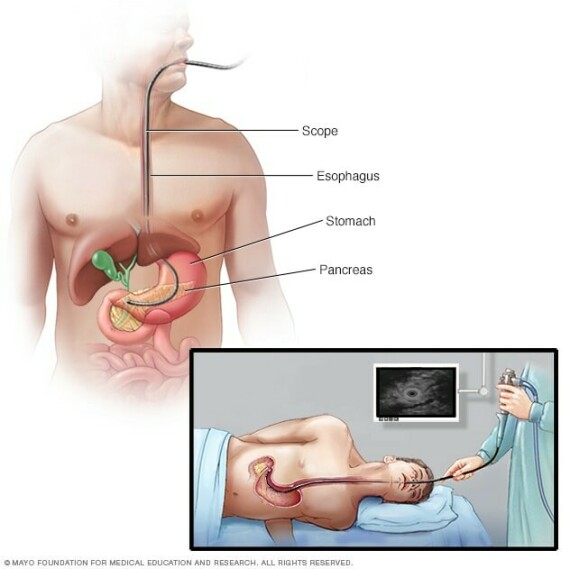 Siêu âm tuyến tụy. (Nguồn ảnh mayoclinic.org)