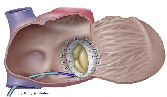 Phương pháp can thiệp qua đường ống thông để sửa van ba lá. Nguồn ảnh: https://www.heartrhythmjournal.com/ 