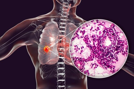 Ung thư tế bào tuyến của phổi, nguồn ảnh drugtargetreview.com