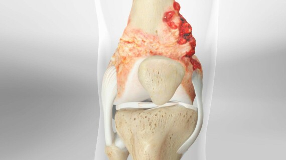 Sarcoma xương (Nguồn ảnh: wkhs.com)