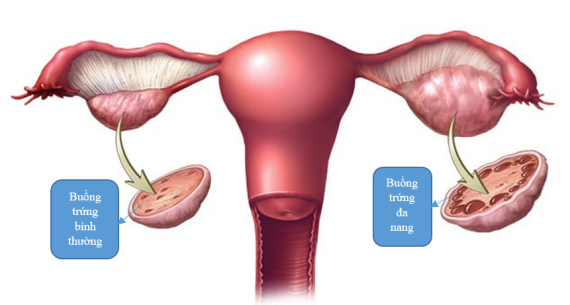 Hiện nay, PCOS là nguyên nhân hàng đầu gây vô sinh ở phụ nữ. nguồn: https://www.mayoclinic.org