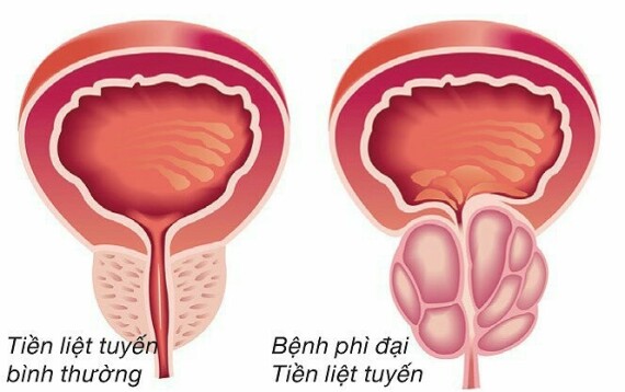 Phì đại tiền liệt tuyến là yếu tố nguy cơ hàng đầu gây hình thành sỏi bàng quang ở nam giới lớn tuổi.   (Nguồn ảnh vinmec.com)