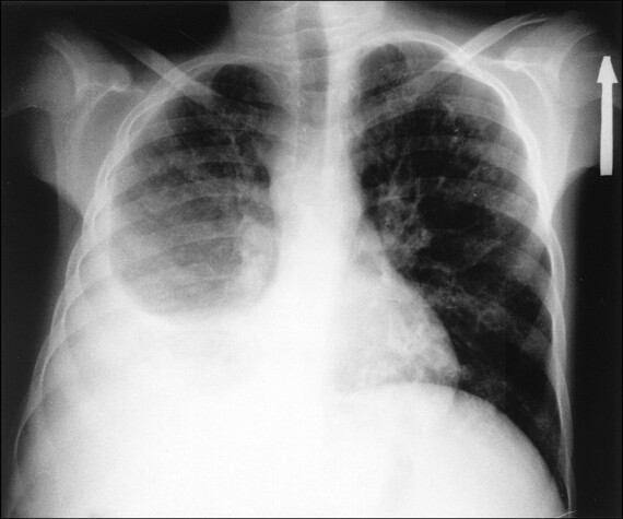 Tràn dịch màng phổi trái trên X quang ngưc của bệnh nhi. Nguồn: Pediatrics in Review