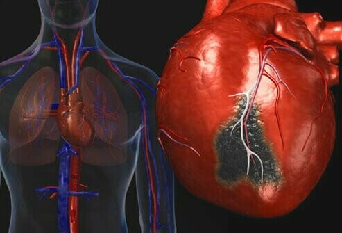 Bệnh tim là bệnh di truyền đa yếu tố (nguồn ảnh: https://www. medicinenet.com/)