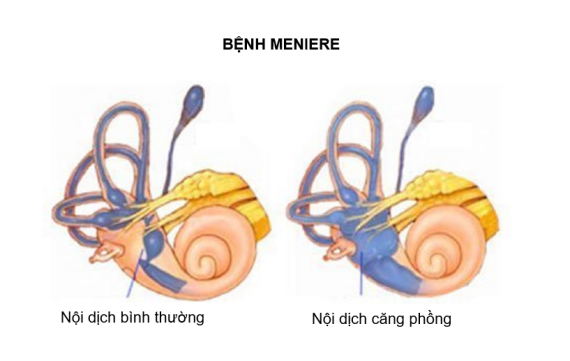 Trong bệnh Meniere, hệ thống ống nội dịch bị giãn rộng (hình bên phải). Nguồn ảnh: chiropracticspecialtycenter.com