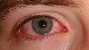Viêm kết mạc còn được hay gọi là đau mắt đỏ, do vi rút gây ra và thường tự khỏi. Nguồn ảnh: https://www.medicalnewstoday.com/