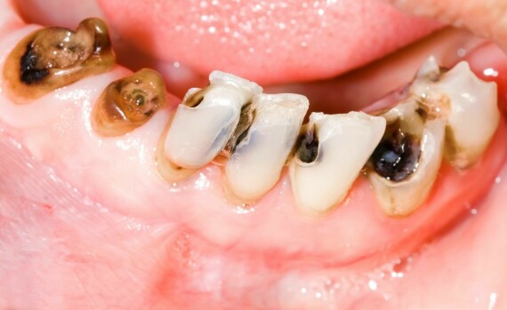 Most Common Symptoms of Tooth DecayChụp răng được chỉ định trong trường hợp thân răng sâu, vỡ lớn. Nguồn ảnh: drsilmansmilespa.com