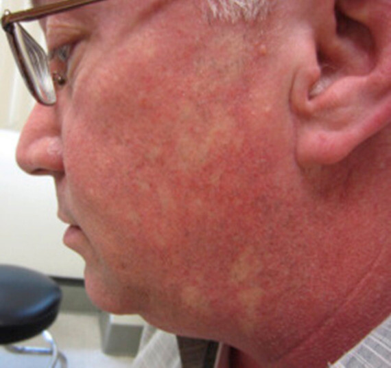 Đỏ bừng mặt có thể là phản ứng phụ khi bạn dùng thuốc điều trị chứng rối loạn cương dương, nguồn ảnh jaad.org