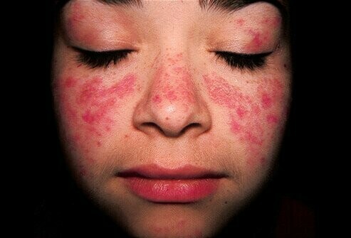 Khuôn mặt của bệnh nhân lupus ban đỏ (nguồn: https://www.medicinenet.com/)