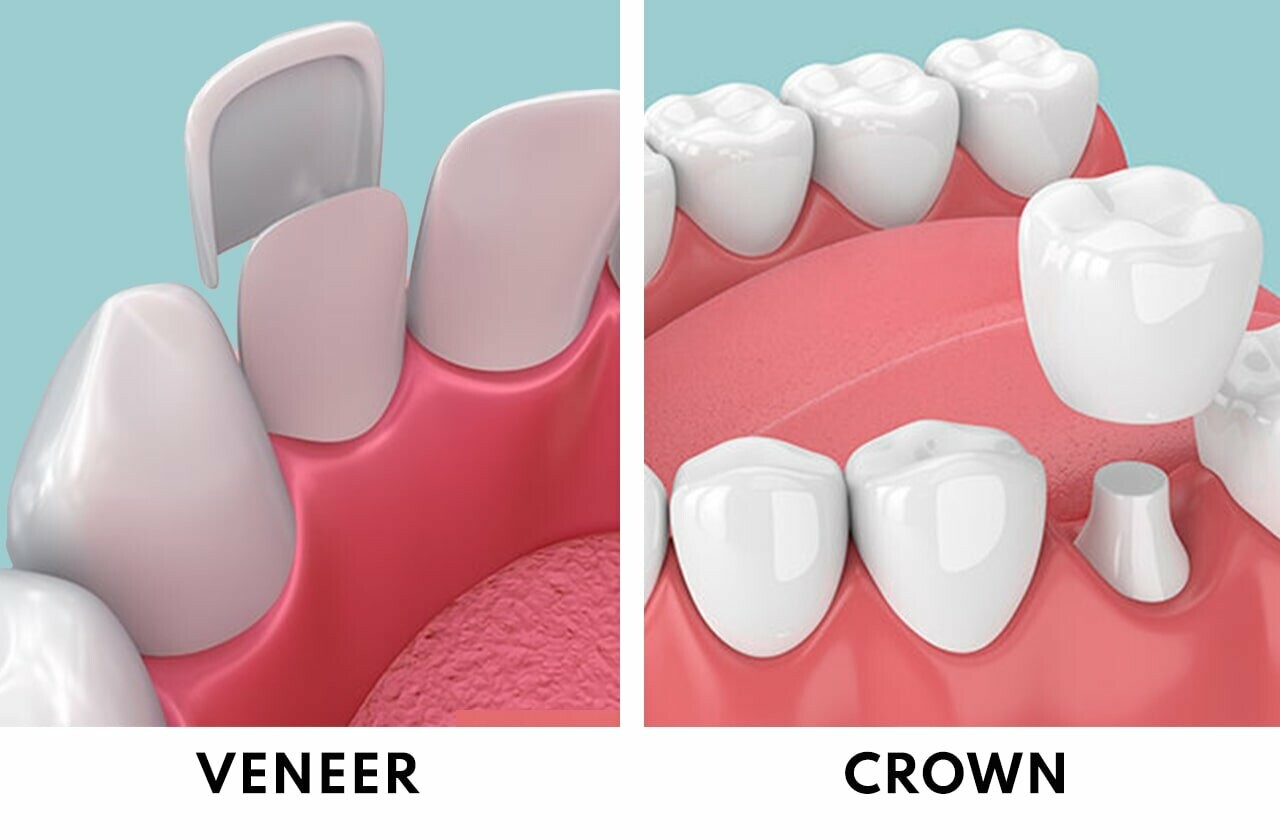 Độ bền của veneer và chụp răng gần như tương đương nhau. Nguồn ảnh: teethtalkgirl.com