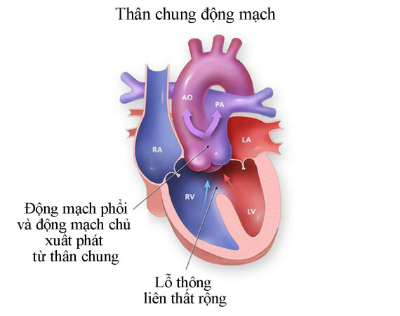 Thân chung động mạch. Nguồn ảnh: chop.edu