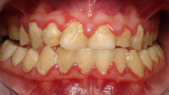 Sự tích tụ mảng bám và cao răng này khiến nướu bị viêm và sưng, đây là giai đoạn đầu của bệnh lý nha chu.   (nguồn: waverleyoaksdental.com)