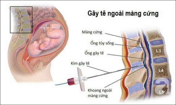 Minh họa thủ thuật gây tê ngoài màng cứng. Nguồn: phsmedicalsolutions.com