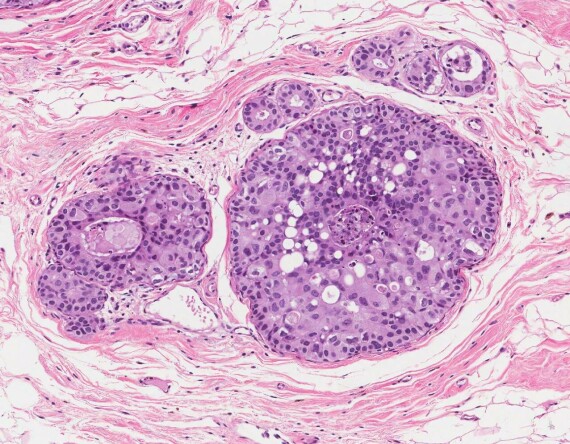 Hình ảnh sinh thiết của ung thư biểu mô ống dẫn sữa tại chỗ, nguồn ảnh mypathologyreport.ca