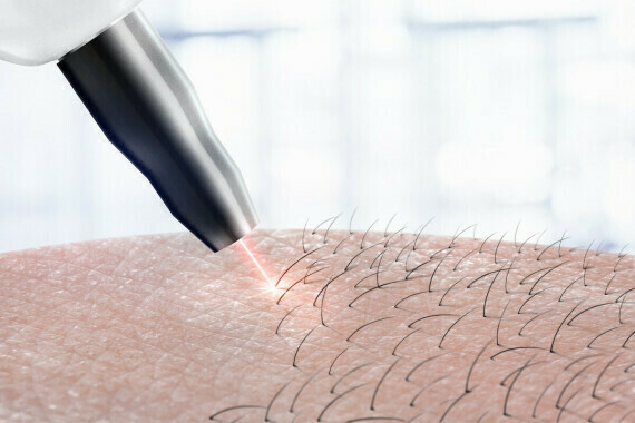 Dùng tia laser để loại bỏ lông vùng hậu môn. Nguồn ảnh: hillandaleprimarycare