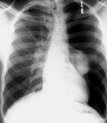 Ảnh chụp X quang tràn khí màng phổi lớn. Nguồn: msdmanuals.com