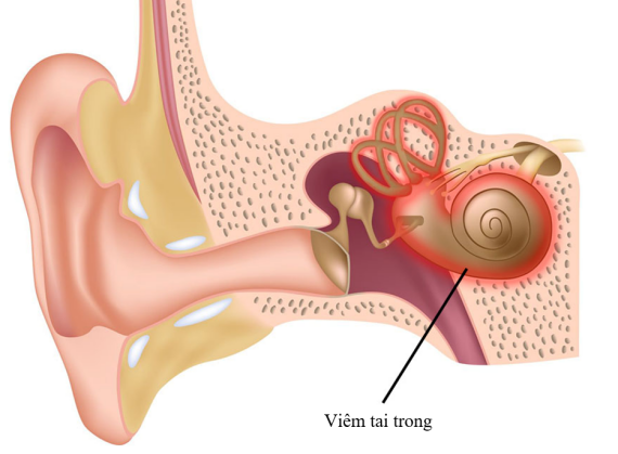 Vị trí mê viêm là mê đạo nằm ở tai trong. Nguồn ảnh: healthdirect.org.au