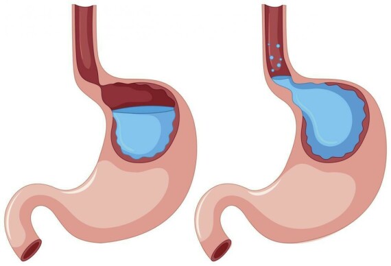 Trào ngược axit dạ dày ( Nguồn ảnh: https://www.medicalnewstoday.com/)