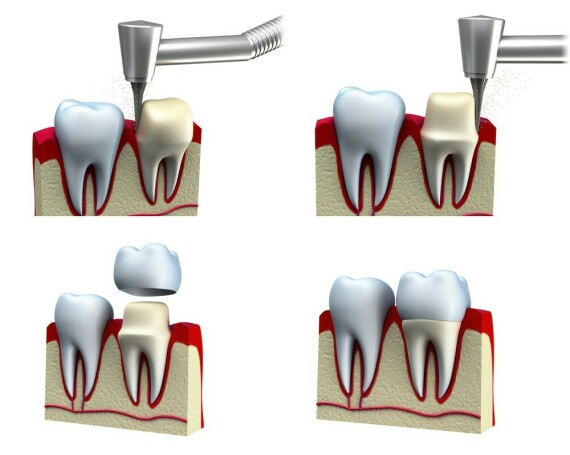 different types of dental crowns 2021 | ilajak medicalSửa soạn cùi răng trước khi lấy dấu làm phục hình. Nguồn ảnh: ilajak.com