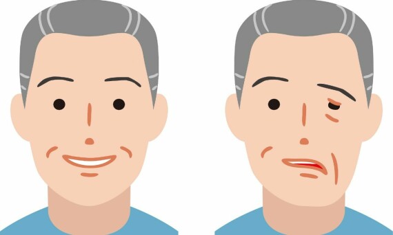 Mất cân xứng trên khuân mặt là một dấu hiệu của bệnh lý tổn thương dây thần kinh mặt. Nguồn ảnh: awatage.com